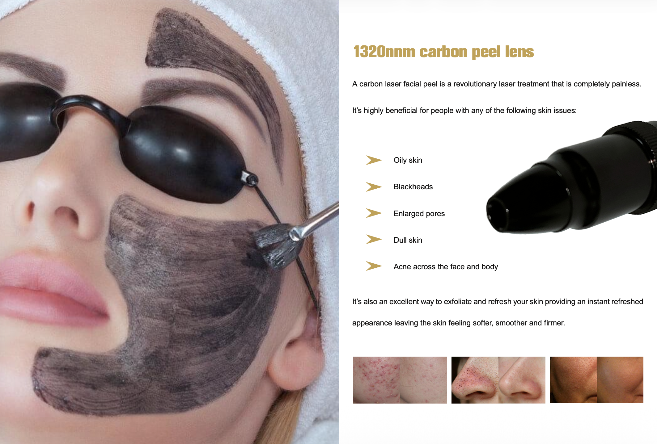 Q-Swithched-Nd-Yag-Laser