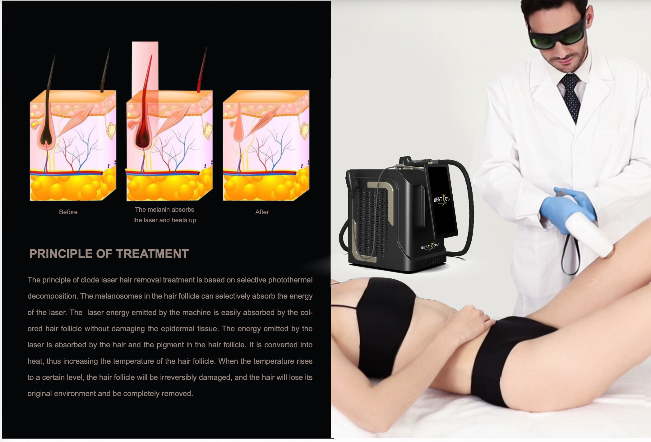 Latest Diode Laser Hair Removal
