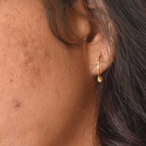VTCT Skills (ITEC) Level 5 Certificate in Advanced Blemish Removal delivered by Best You Training