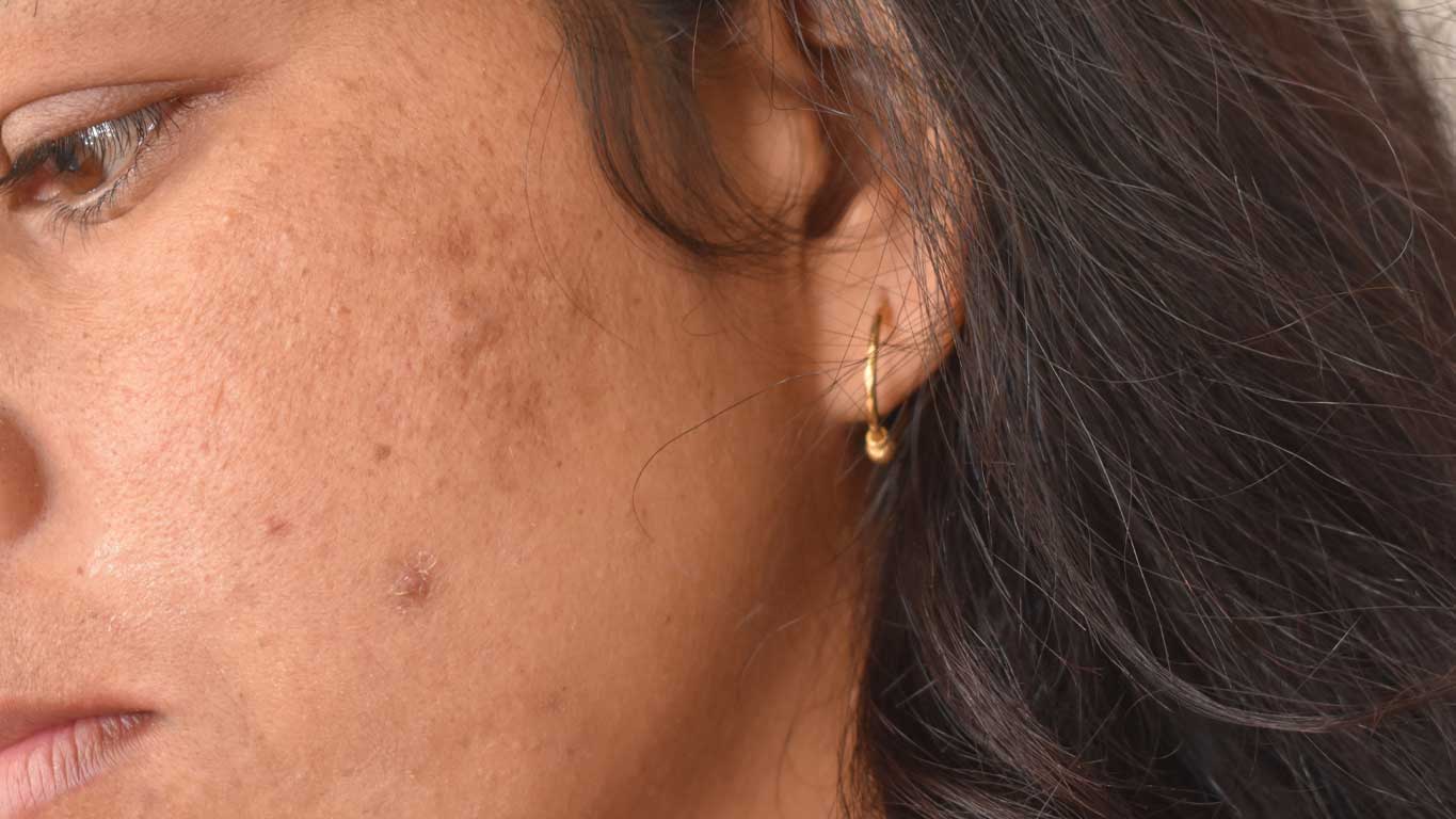 VTCT Skills (ITEC) Level 5 Certificate in Advanced Blemish Removal delivered by Best You Training